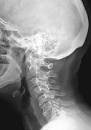Симптомы шейного остеохондроза: полное описание