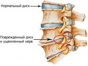 Головные боли при шейном остеохондрозе: лечение