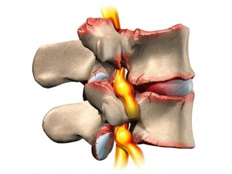 Шейно-плечевые синдромы остеохондроз шейного отдела