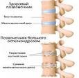 Медикаментозное лечение остеохондроза шейного отдела
